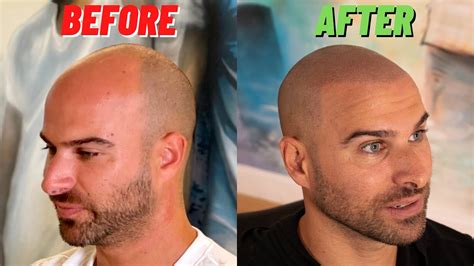 scalp micropigmentation wimbledon|Scalp Micropigmentation: Before & After, Benefits, Side Effects.